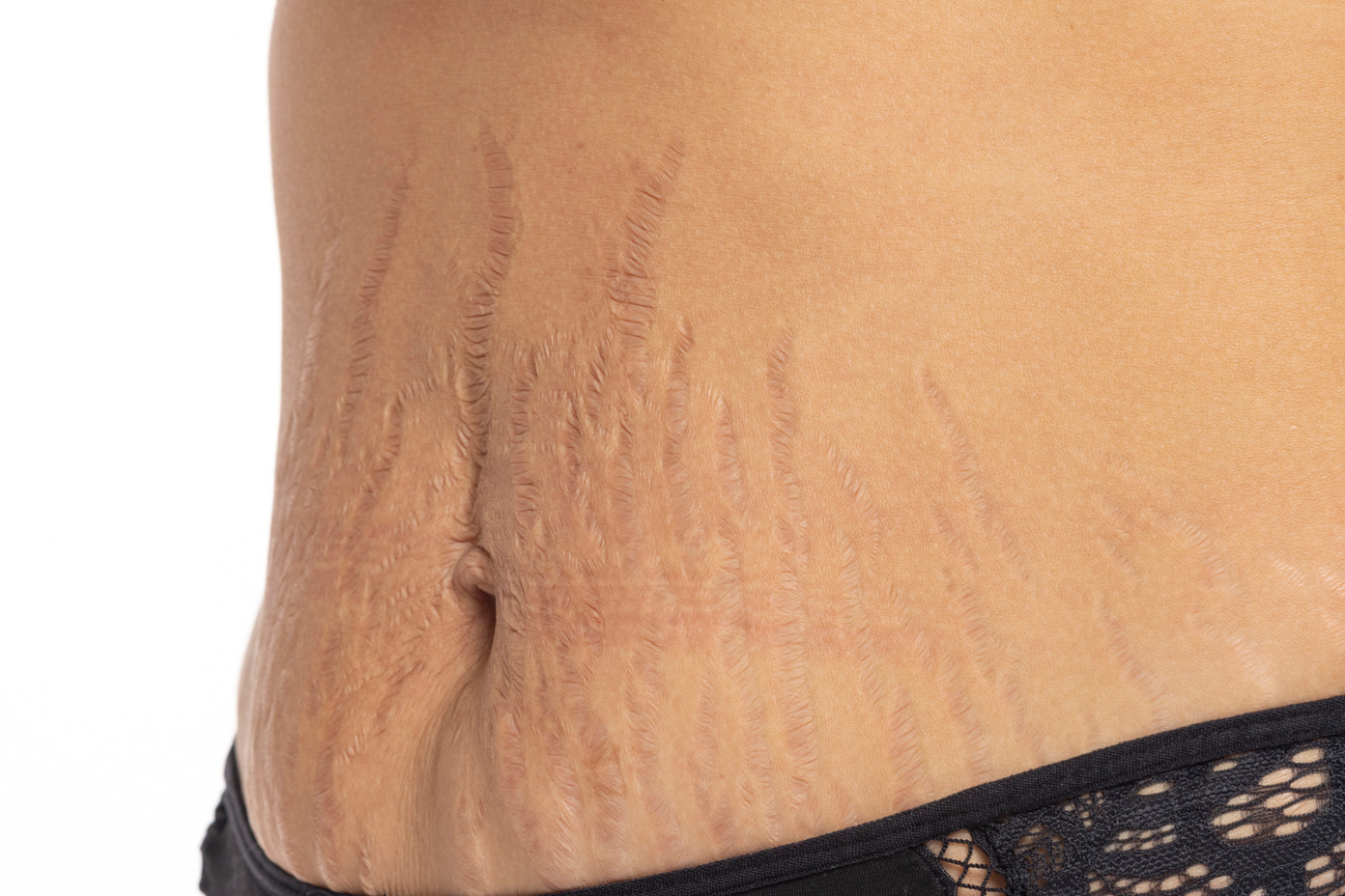 Female belly with stretch marks